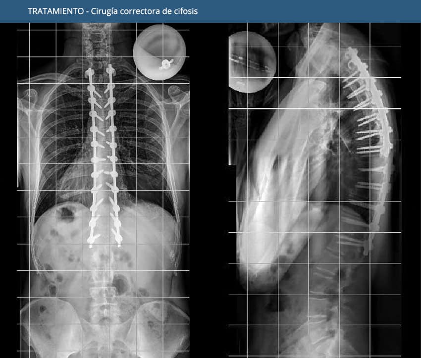 Cifosi - Tractament - Cirurgia