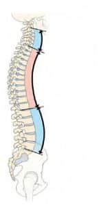 Columna vertebral sana - Escoliosi
