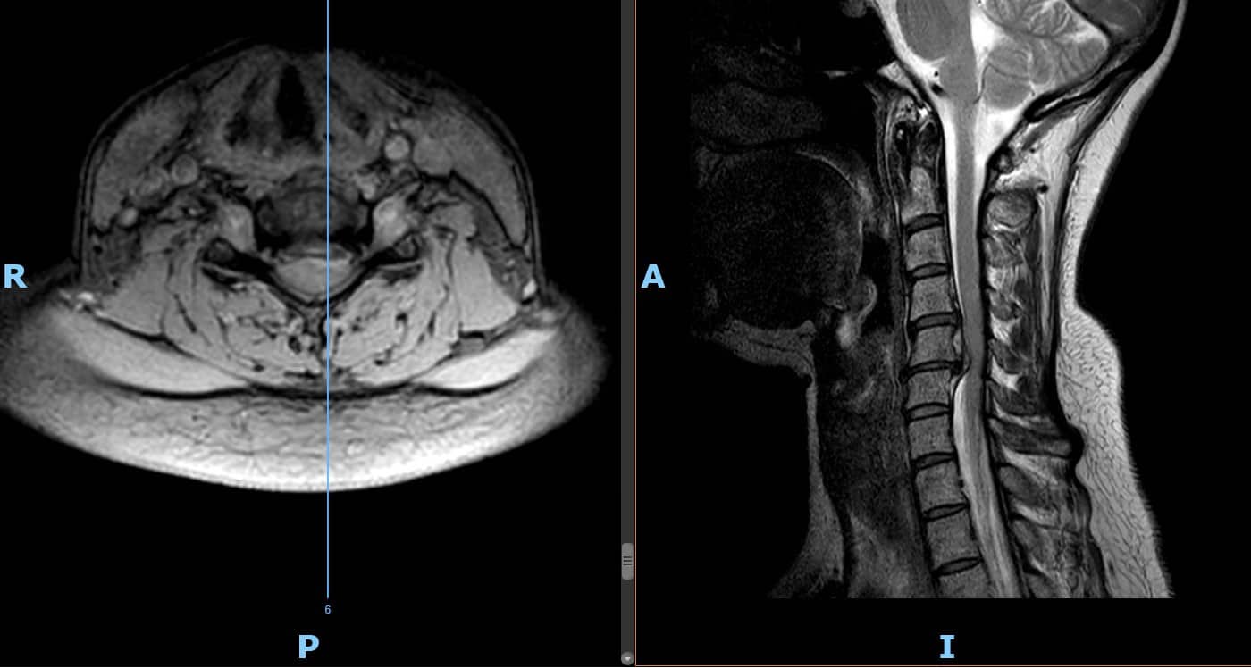 Mielopatia cervical