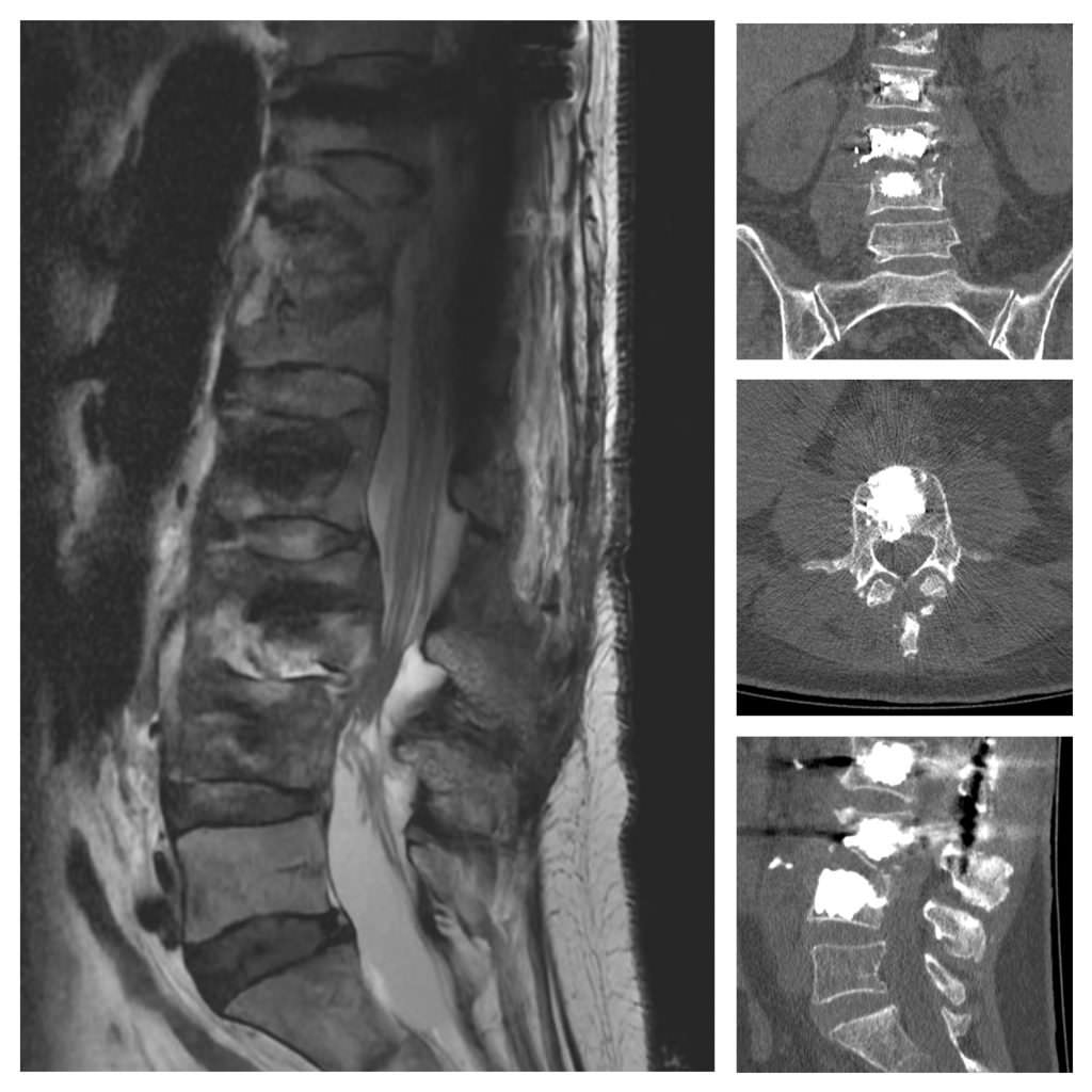 Infecció columna - discitis
