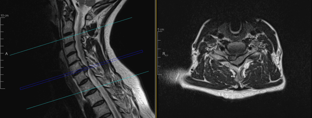Mielopatia Cervical
