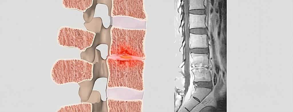 Infecció de columna - Discitis