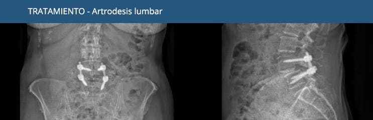 Artrodesi lumbar