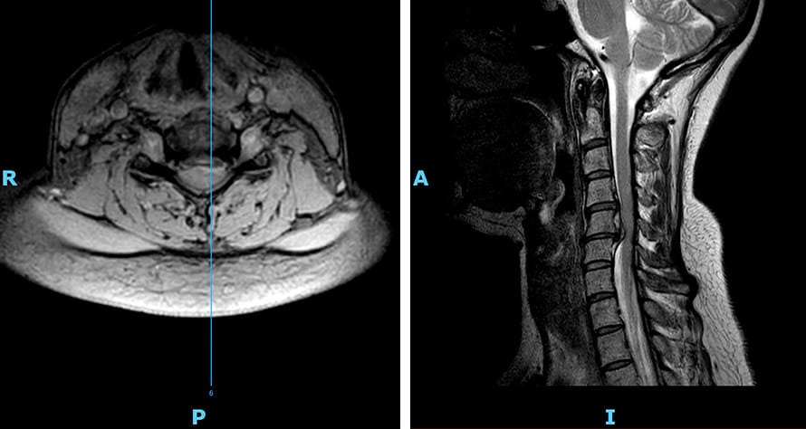 Hèrnia discal cervical - Abans cirurgia