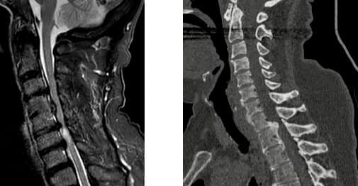 Hernia Discal Cervical - Conmielopatia vs Calcificada