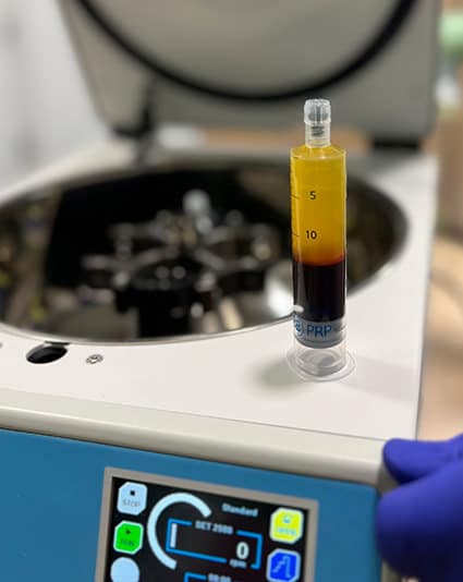 Tractament de Plasma Ric en Plaquetes (PRP)