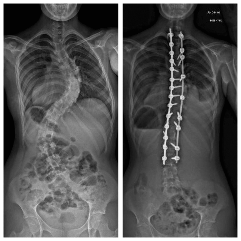 ESCOLIOSIS_BSI Escoliosis